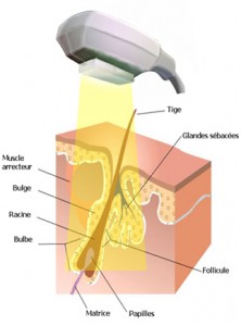 schema-photodepilation